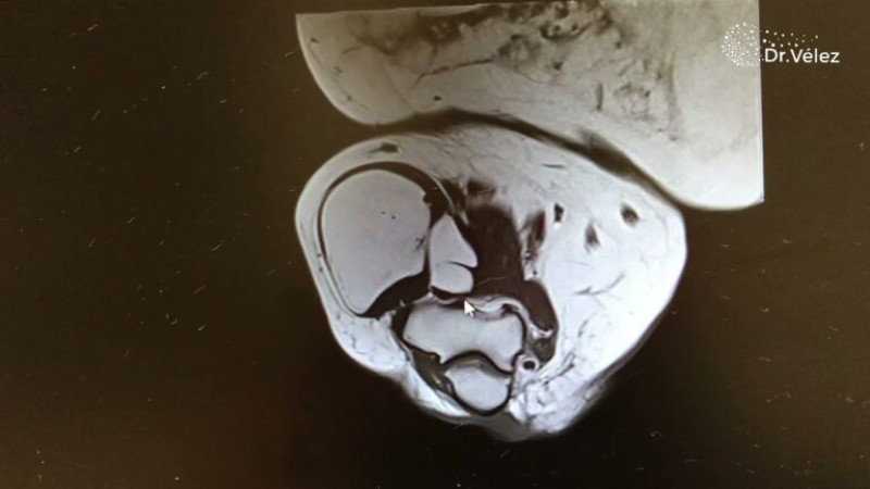 dias-de-baja-por-cirugia-ambulatoria