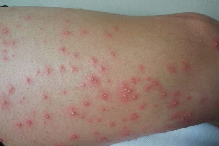 Foliculitis por Pseudomonas: Una infección cutánea común pero problemática